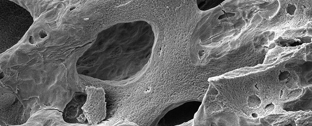 骨质疏松症的电子显微镜图像。